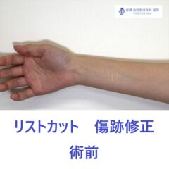 AA　傷跡右前腕　術前 (1)