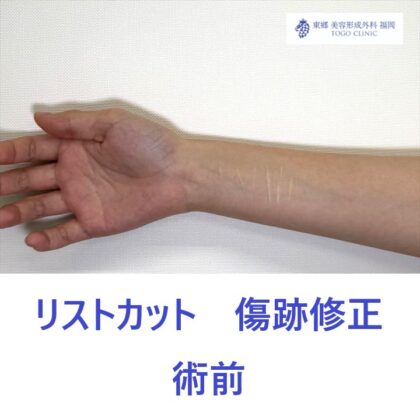 AA　傷跡右前腕　術前 (1)