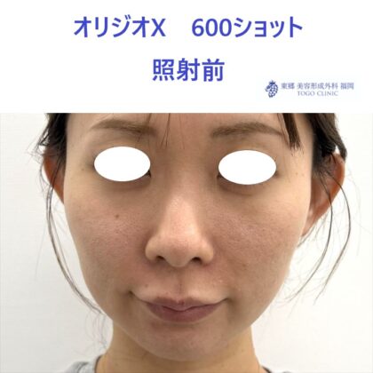 AO　ｵﾘｼﾞｵ術前