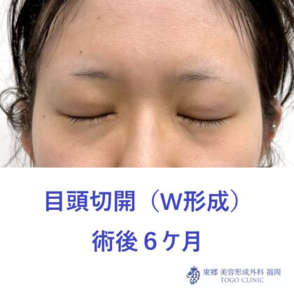 MK　目頭6M - コピー