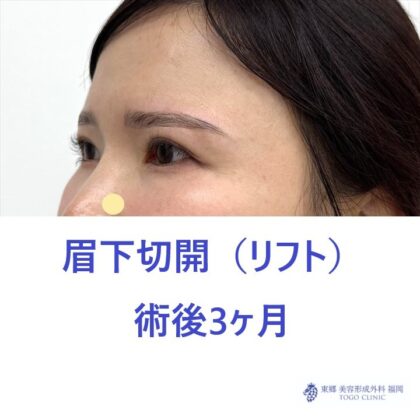 IM　眉下術後 (2)2
