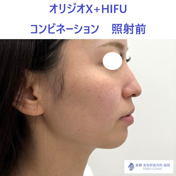 MY　ｵﾘｼﾞｵ術前 (3)