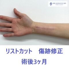 AA　傷跡右前腕　術後