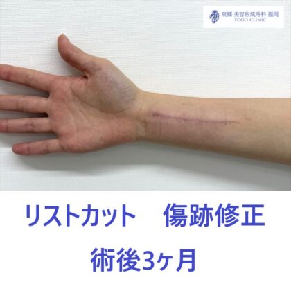 AA　傷跡右前腕　術後