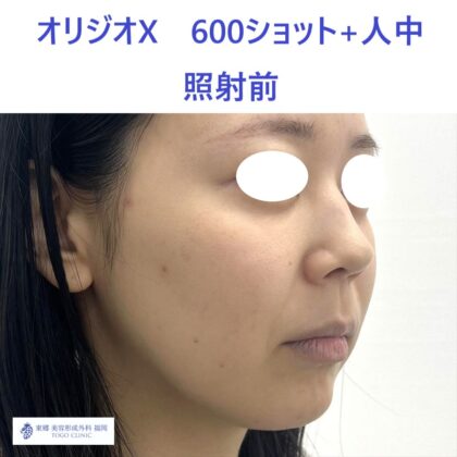 SK ｵﾘｼﾞｵ術前 (2)