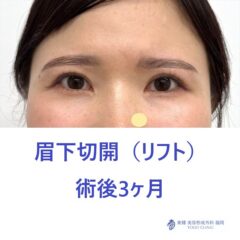 IM　眉下術後2