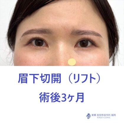 IM　眉下術後2