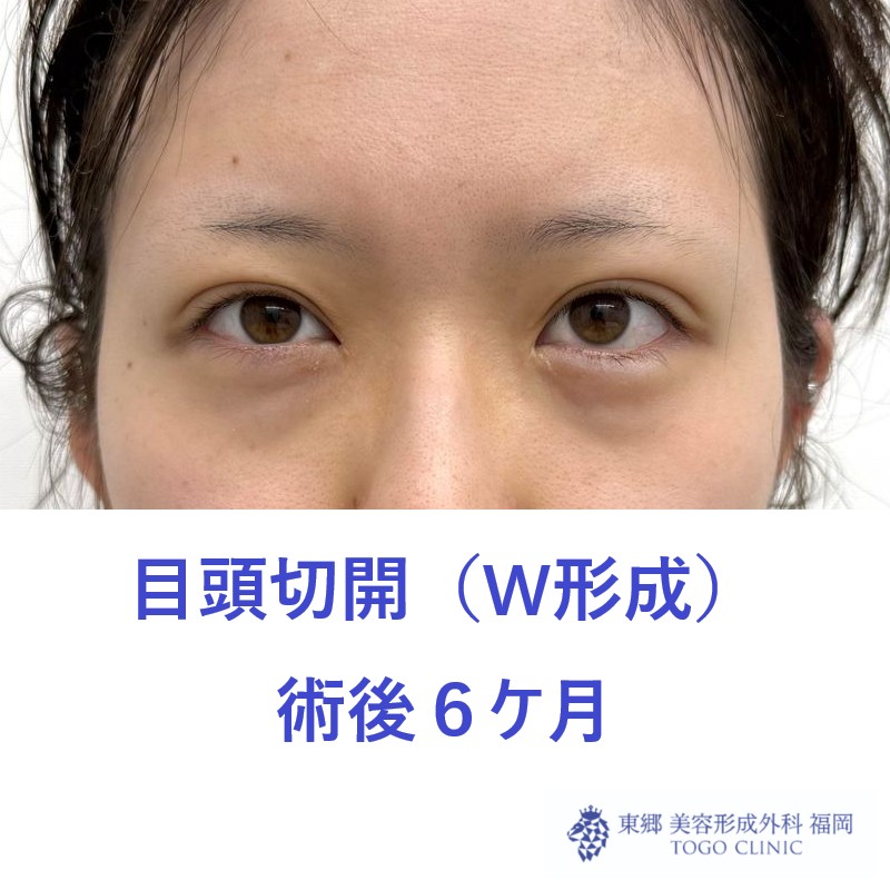 MK　目頭6M (2) - コピー