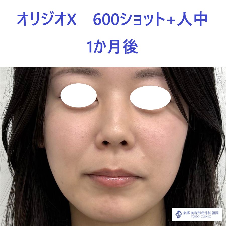 SK　オリジオ術後