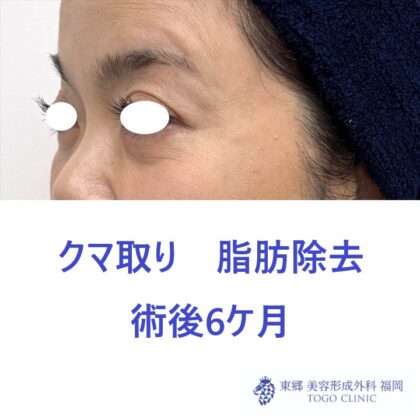 MK　経結膜　術後 (3)