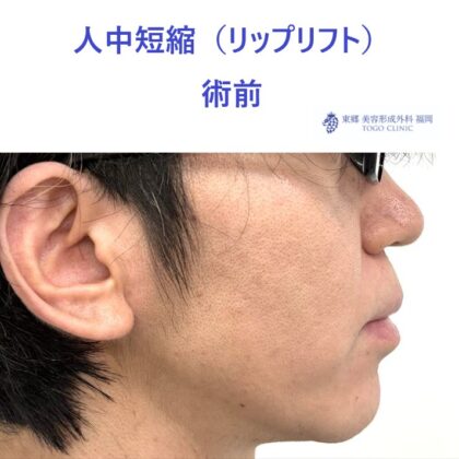 AO　リップリフト術前 (2)