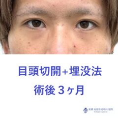 RN　目頭+埋没術後