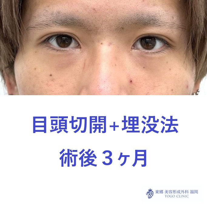 RN　目頭+埋没術後