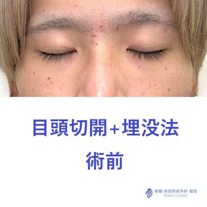 RN　目頭+埋没術前 (2)