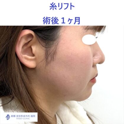 SO　糸リフト術後 (3)