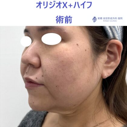 KU　ｵﾘｼﾞｵ術前 (2)