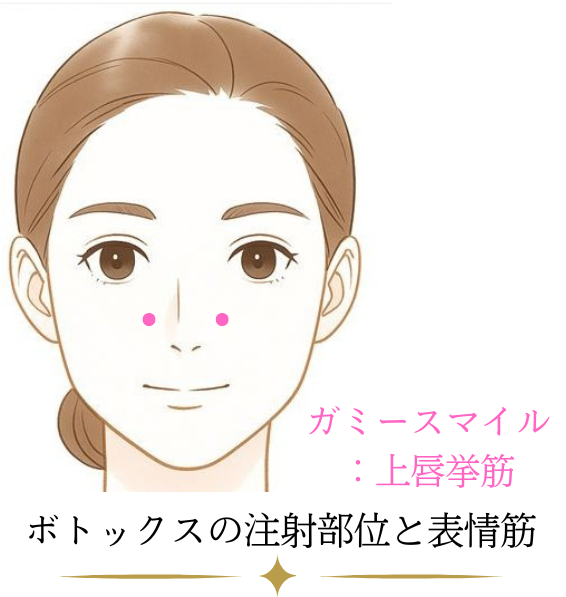 ガミースマイル　ボトックスのデザイン