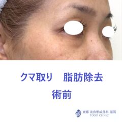 KH 経結膜 術前 (2)