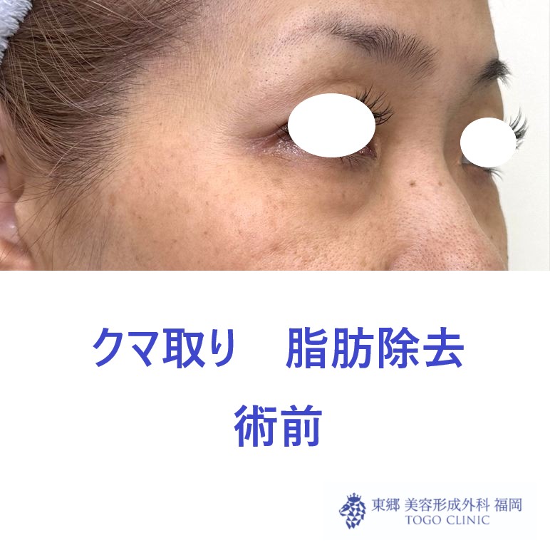 KH　経結膜　術前 (2)