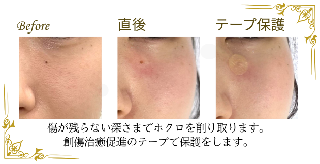 福岡でホクロ除去のおすすめクリニック