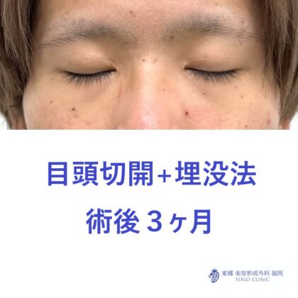 RN　目頭+埋没術前後(2)