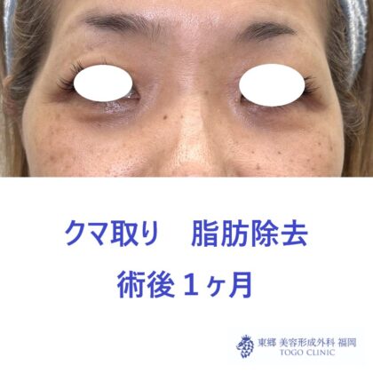 KH　経結膜　術後