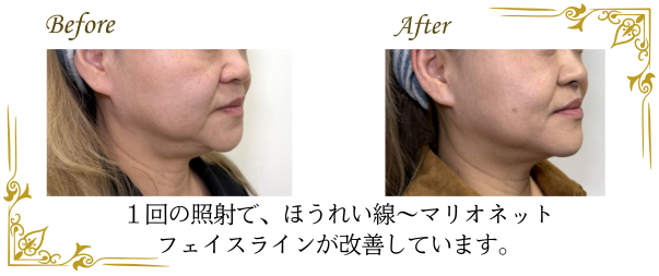 オリジオによるたるみ改善効果