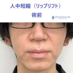 AO　リップリフト術前