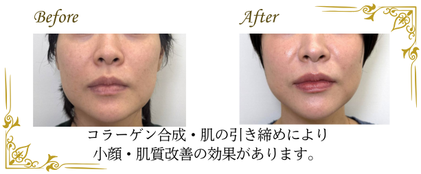 オリジオによる、小顔・肌質改善効果