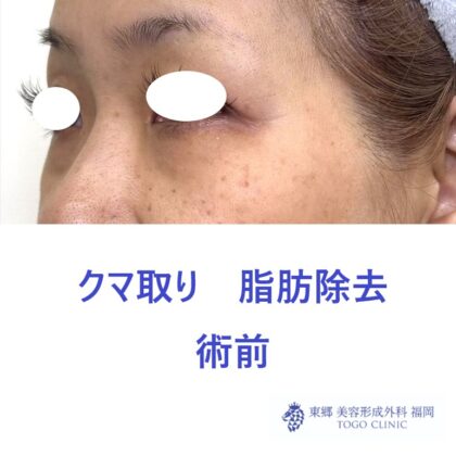 KH　経結膜　術前