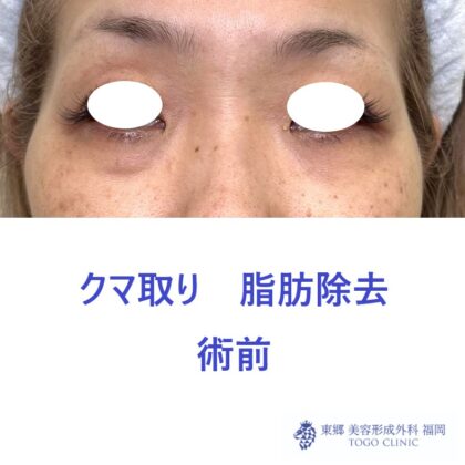 KH 経結膜　術前