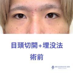 RN　目頭+埋没術前