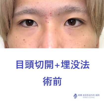 RN　目頭+埋没術前