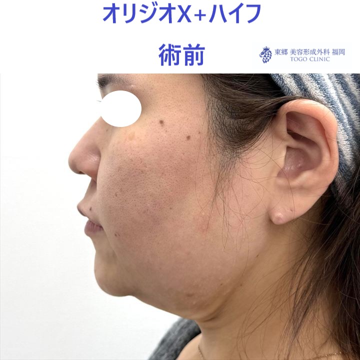 KU　ｵﾘｼﾞｵ術前 (3)