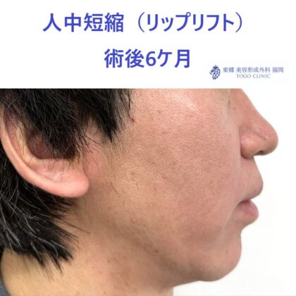 AO　リップリフト術後 (2)