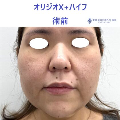 KU　ｵﾘｼﾞｵ術前