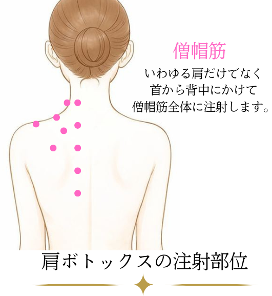 肩ボトックスの注射部位