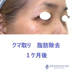 KH 経結膜 術後 (2)