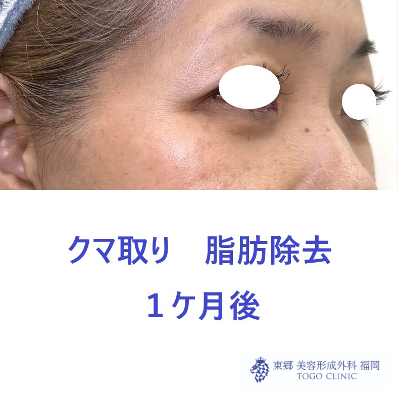 KH　経結膜　術後 (2)