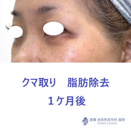 KH　経結膜　術後 (3)