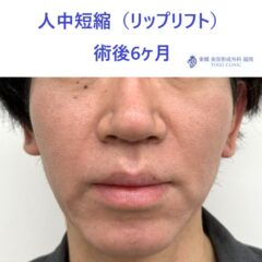 AO　リップリフト術後