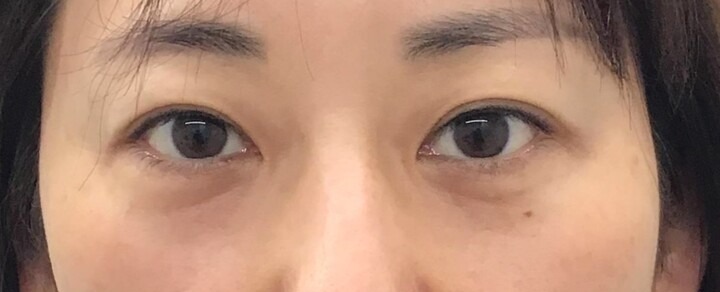 黒クマ　施術後の印象