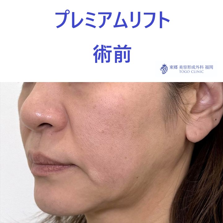 ME　糸リフト術前