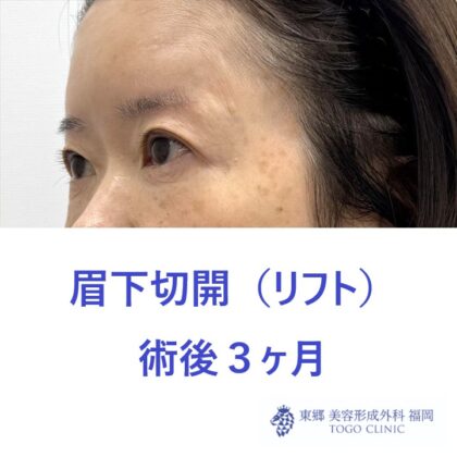 NK　眉下術後３M (2)