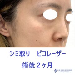 TS シミピコ 術後