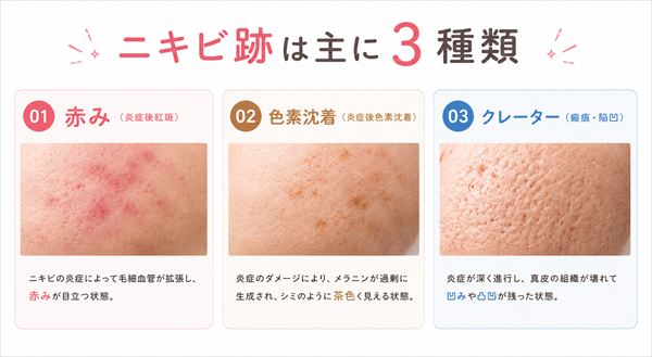 ニキビ跡の３つの種類