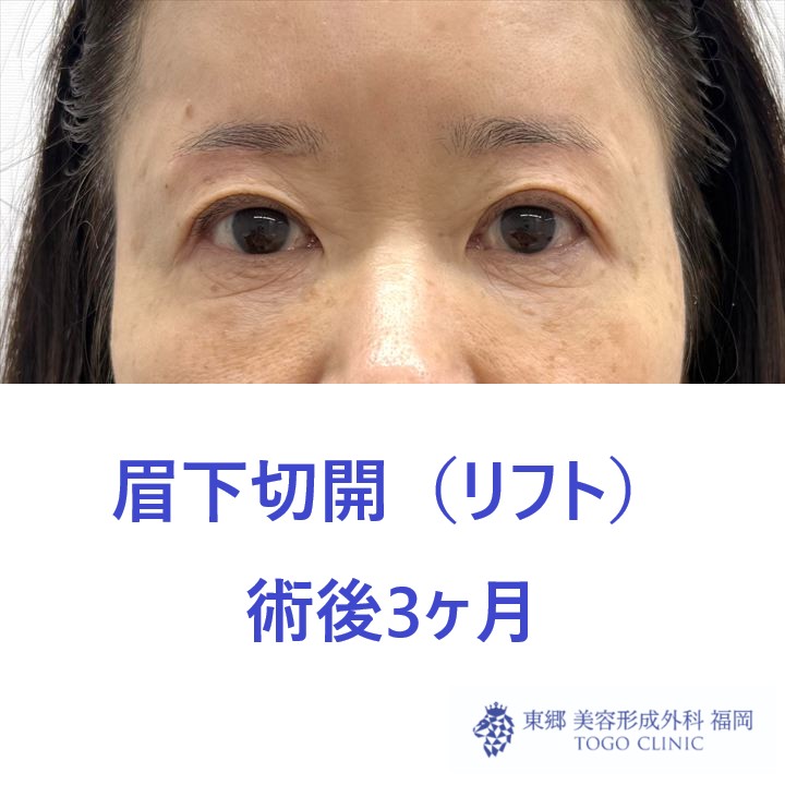 NK　眉下術後３M