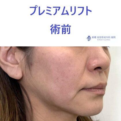 ME　糸リフト術前 (2)