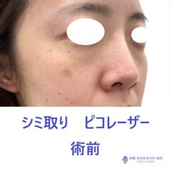 TS シミピコ 術前