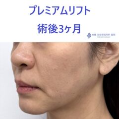 ME　糸リフト術後